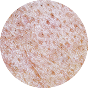 아이스픽 흉터 사진