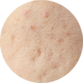 롤링 흉터 사진