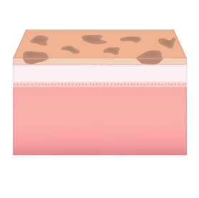 표피 색소 피부층 사진