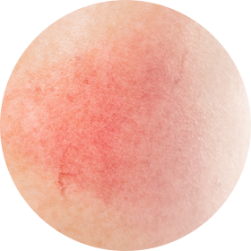 안면홍조증 사진