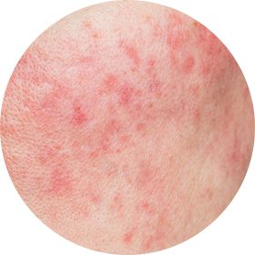 모세혈관확장증 사진