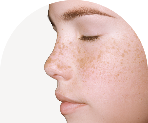 난치성 색소 치료 사진