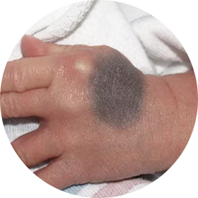 이소성 몽고반점 사진