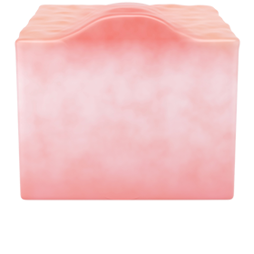 켈로이드 흉터 사진