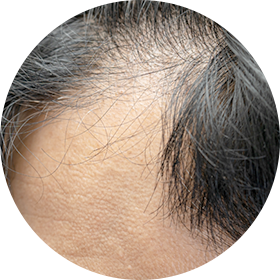 남성형 탈모 사진