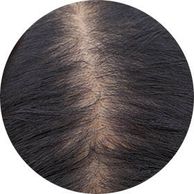 여성형 탈모 사진