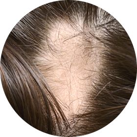 원형 탈모 사진