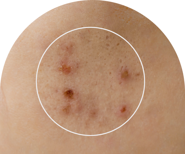 검버섯·사마귀·쥐젖 사진