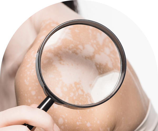 백반증·건선 다리 사진