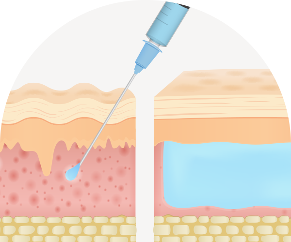 필러시술 피부층사진