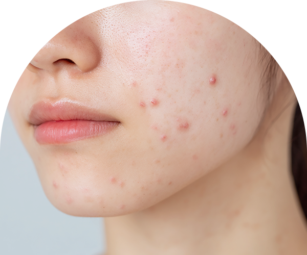 여드름·여드름자국 사진