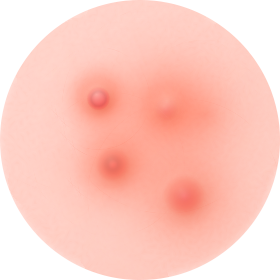 연포성 여드름 사진