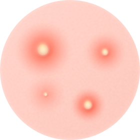 화농성 여르름 사진