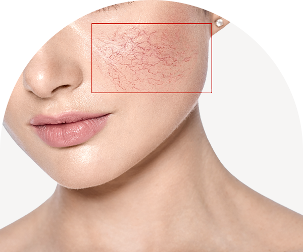 홍조·붉은자국·멍 사진