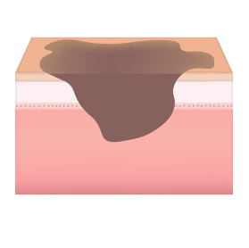 진피 색소 피부층 사진