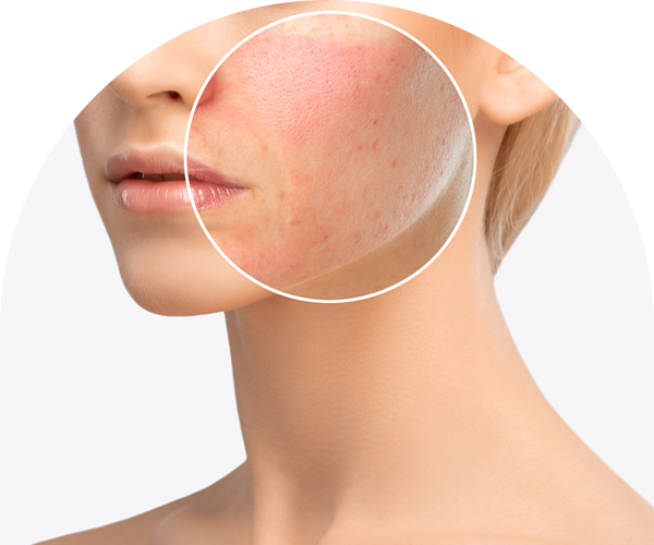 안면홍조·혈관 질환 사진