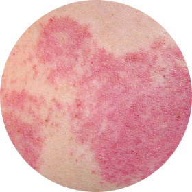 화염상모반 사진