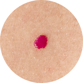 체리혈관종 사진