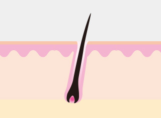 레이저제모 시술과정_2