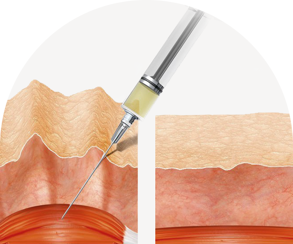 보톡스시술 피부층사진