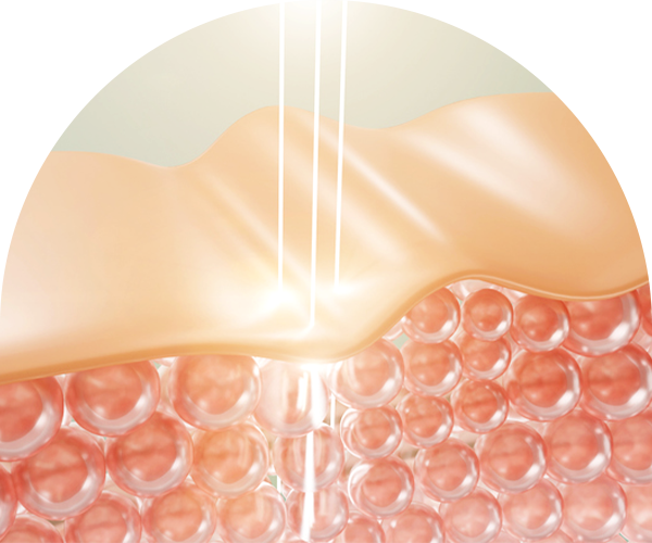 고주파리프팅 피부층사진