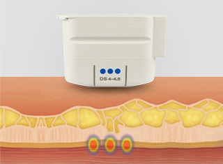 울쎄라피프라임 시술과정_3